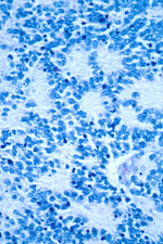 imamgine neuroblastoma